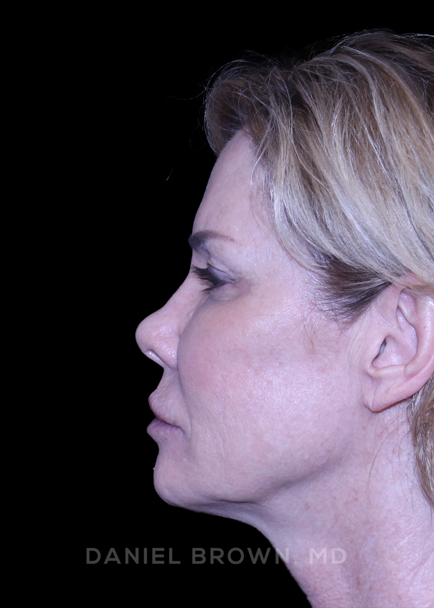 Blepharoplasty Patient Photo - Case 894 - before view-4