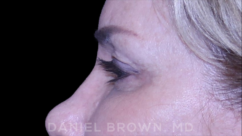 Blepharoplasty Patient Photo - Case 894 - before view-5