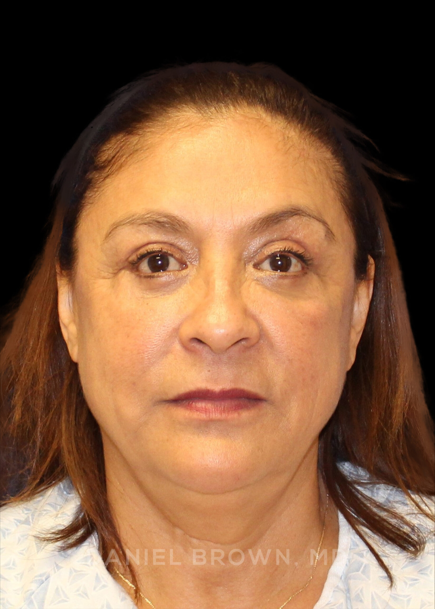 Blepharoplasty Patient Photo - Case 915 - after view-0