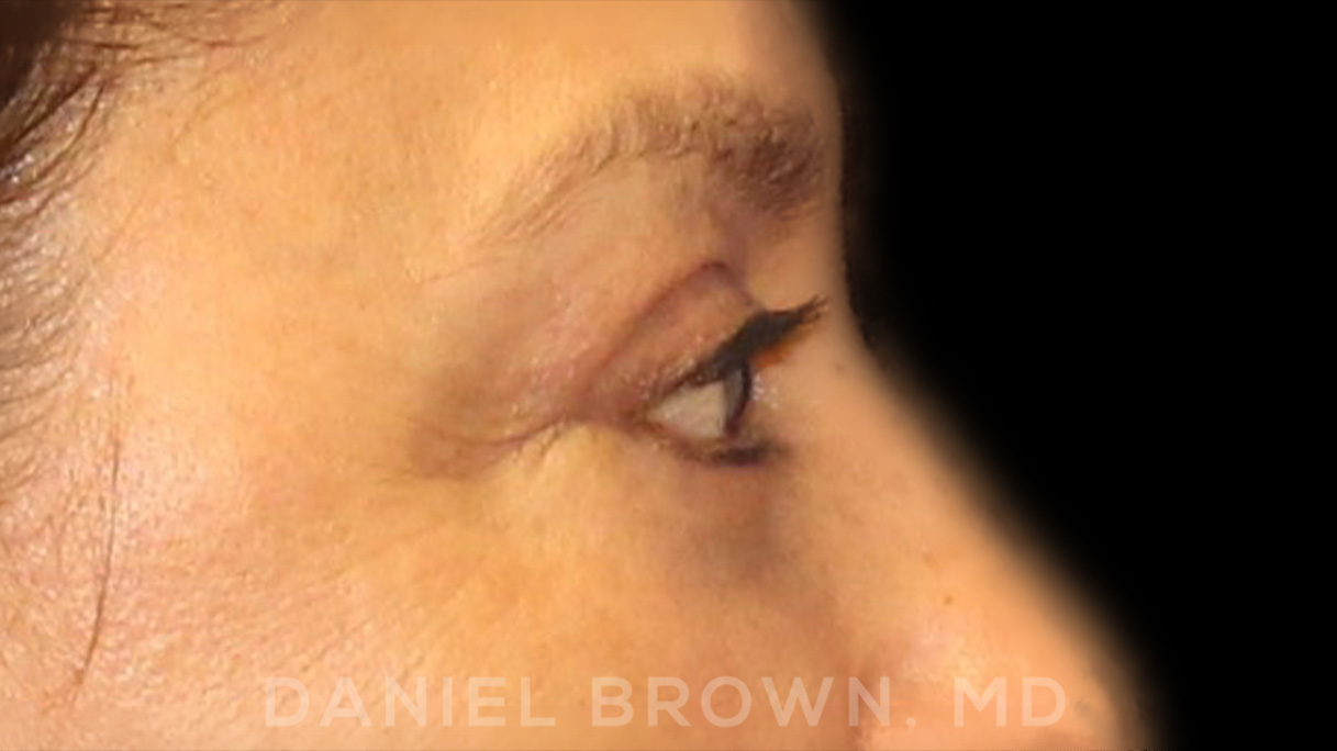 Blepharoplasty Patient Photo - Case 915 - after view-7