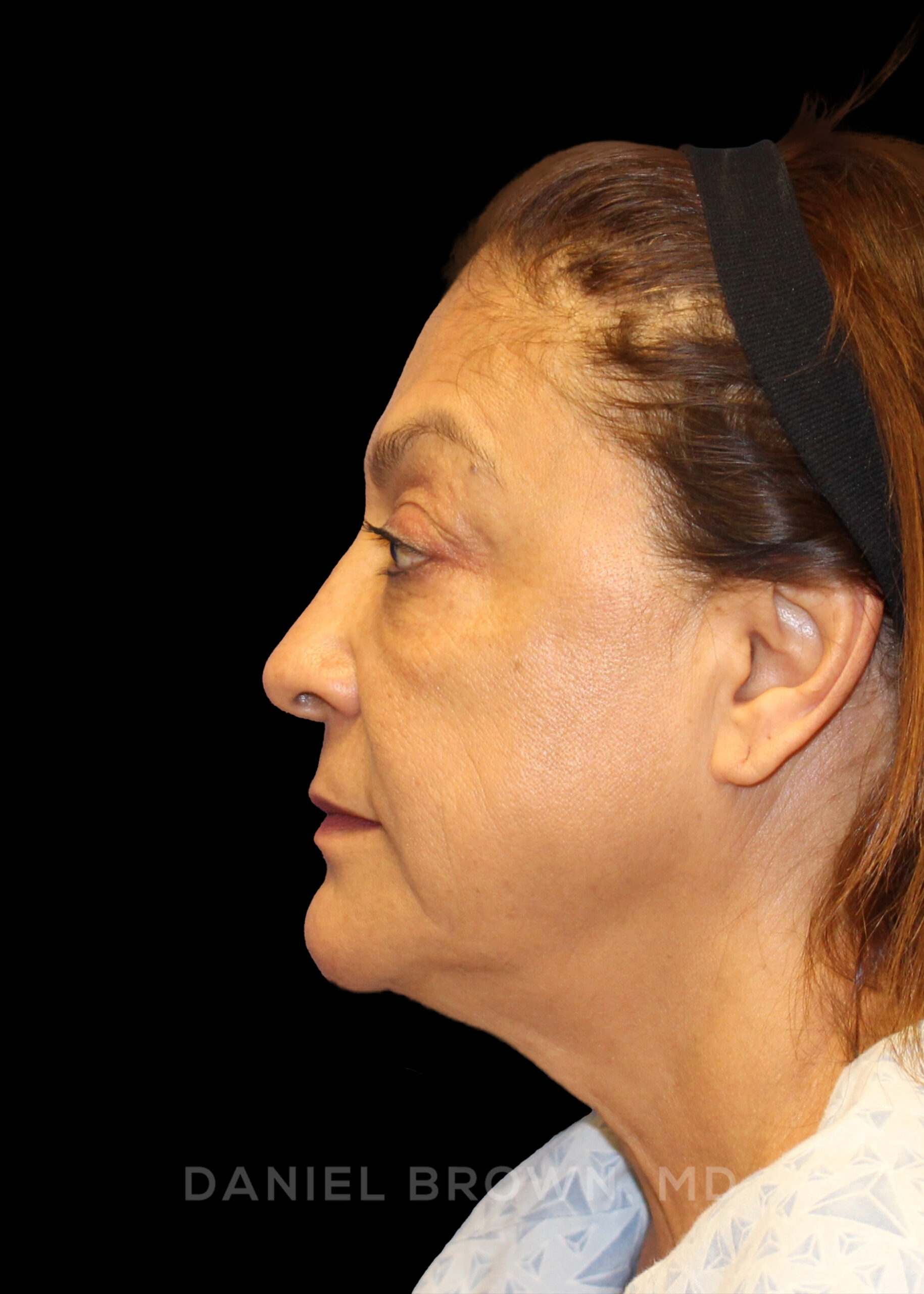 Blepharoplasty Patient Photo - Case 915 - before view-4