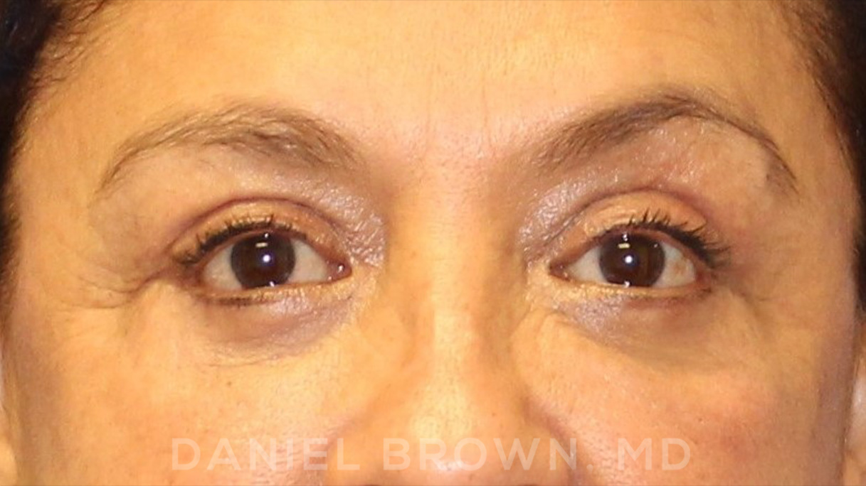 Blepharoplasty Patient Photo - Case 915 - after view-1