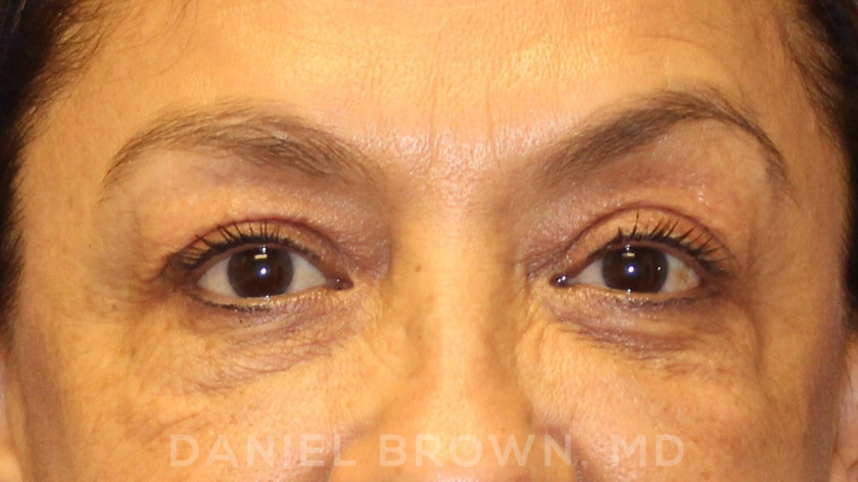 Blepharoplasty Patient Photo - Case 915 - before view-1