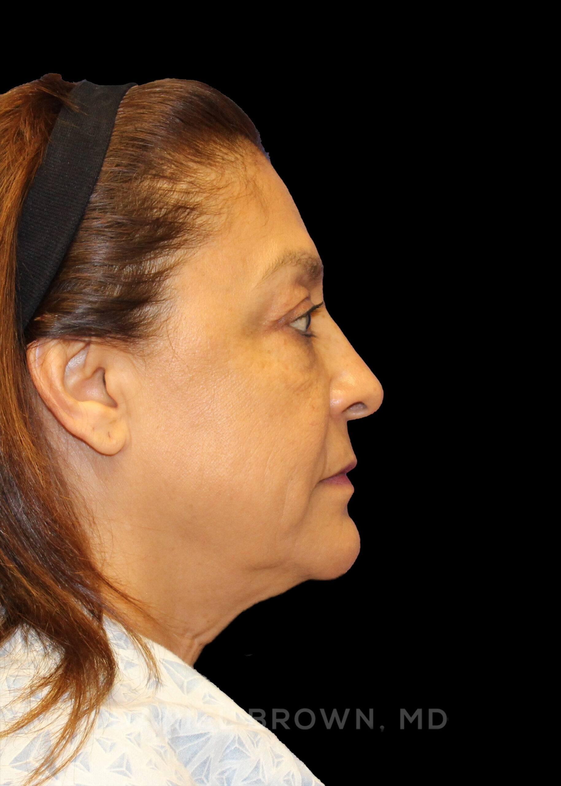 Blepharoplasty Patient Photo - Case 915 - before view-