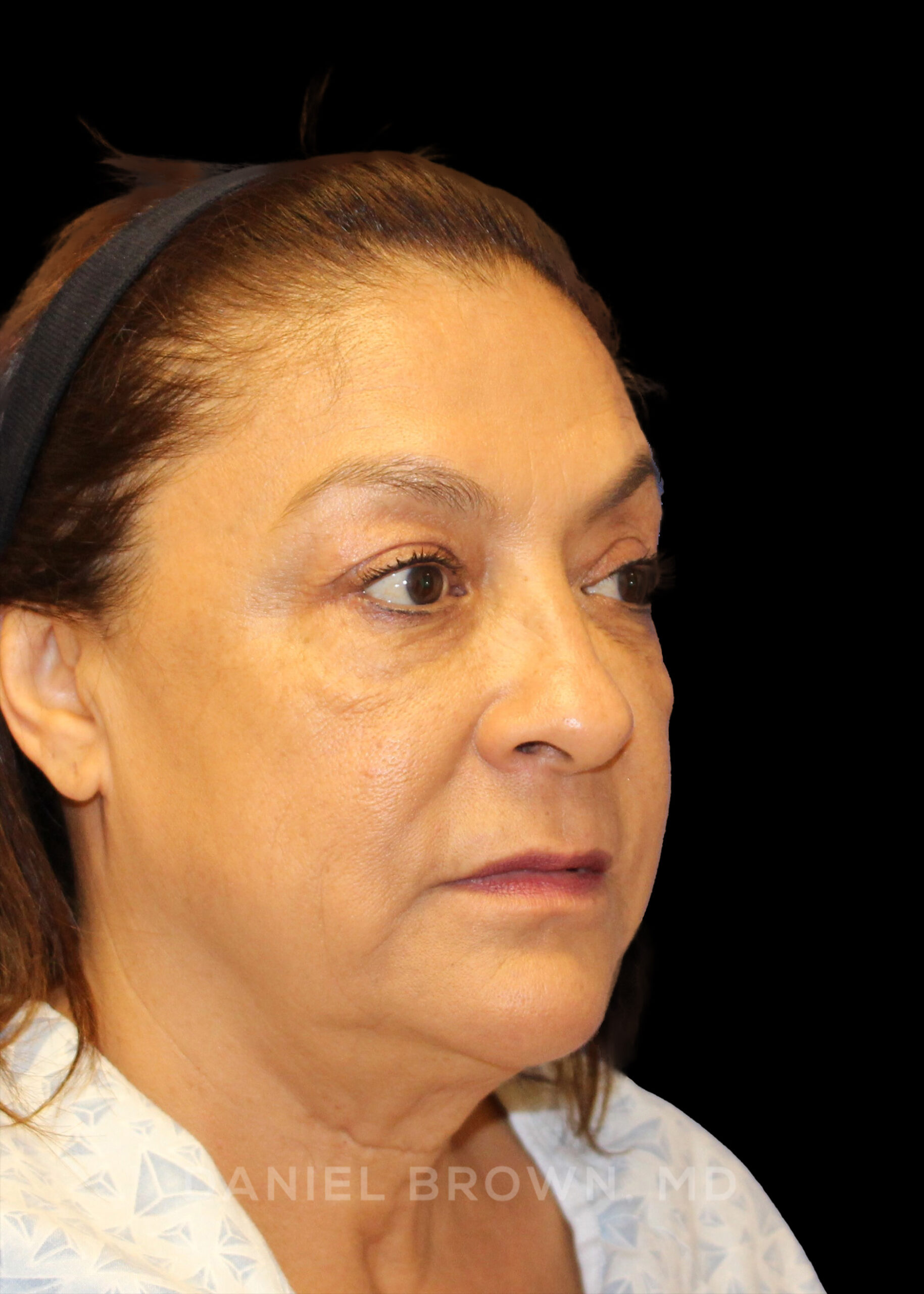 Blepharoplasty Patient Photo - Case 915 - before view-