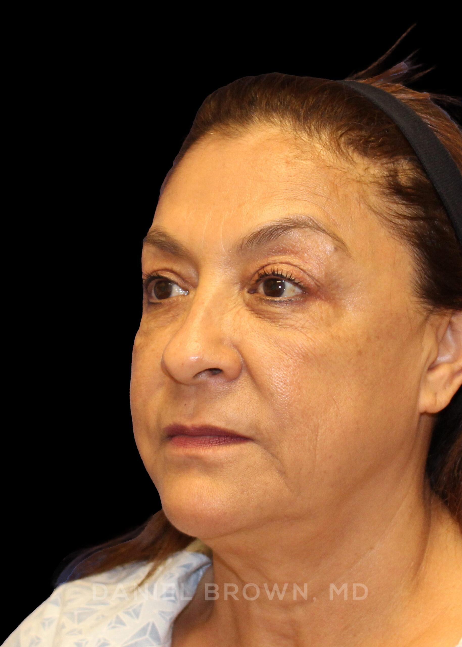 Blepharoplasty Patient Photo - Case 915 - before view-3