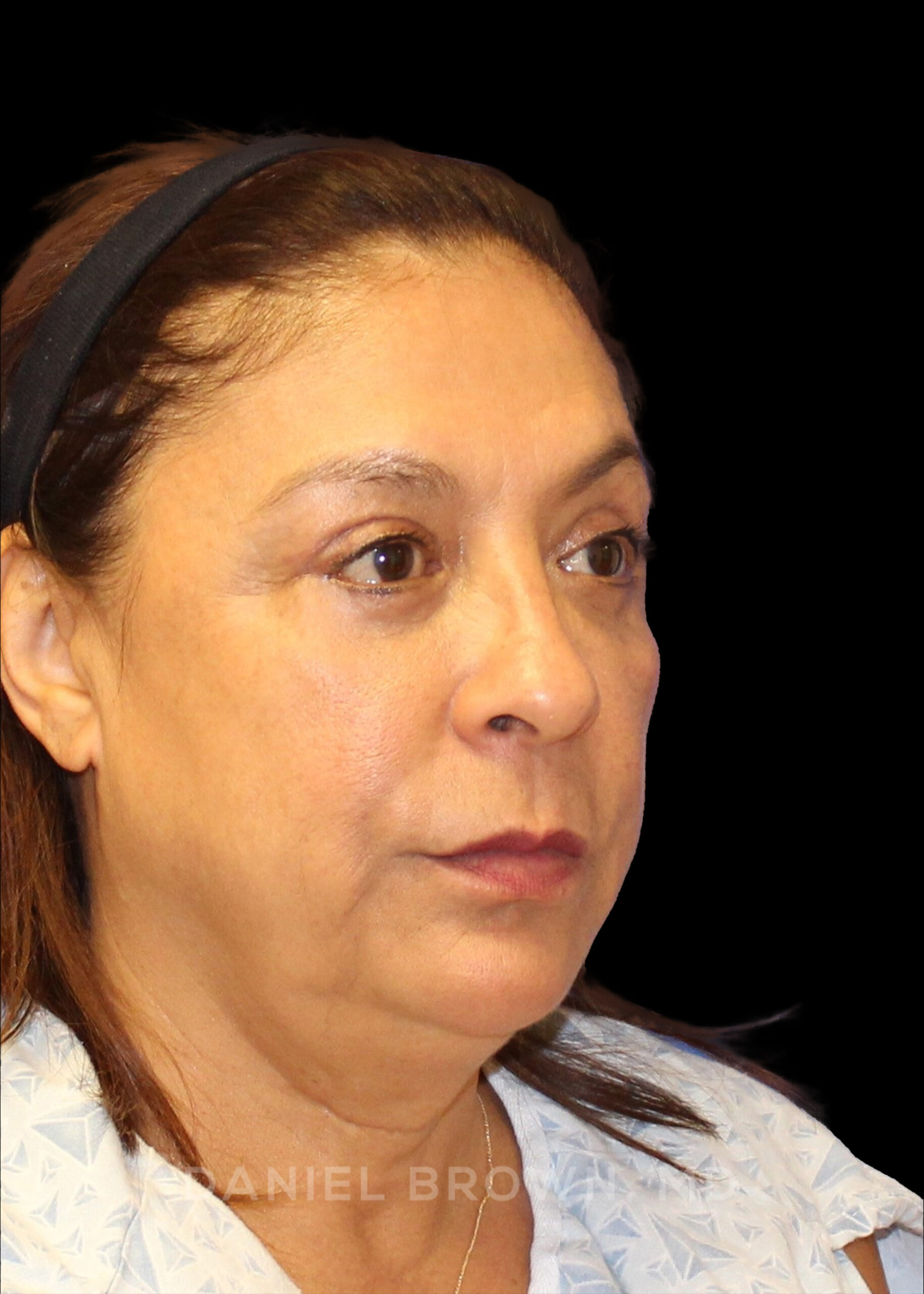 Blepharoplasty Patient Photo - Case 915 - after view-8