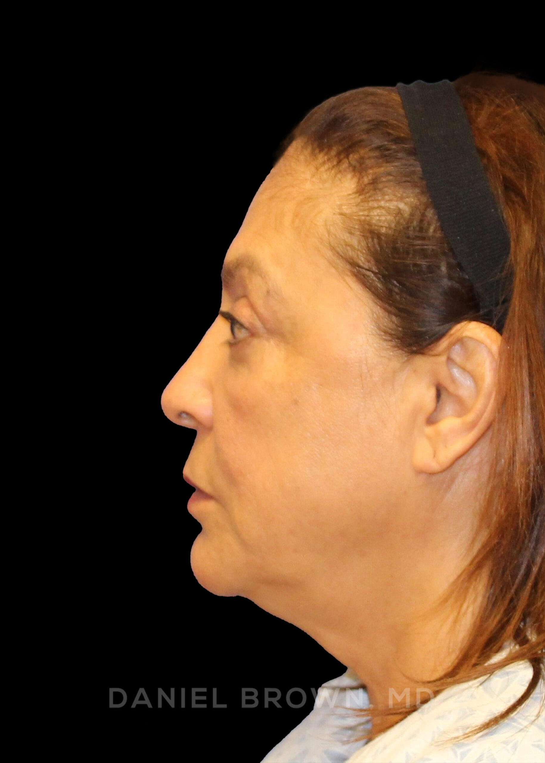 Blepharoplasty Patient Photo - Case 915 - after view