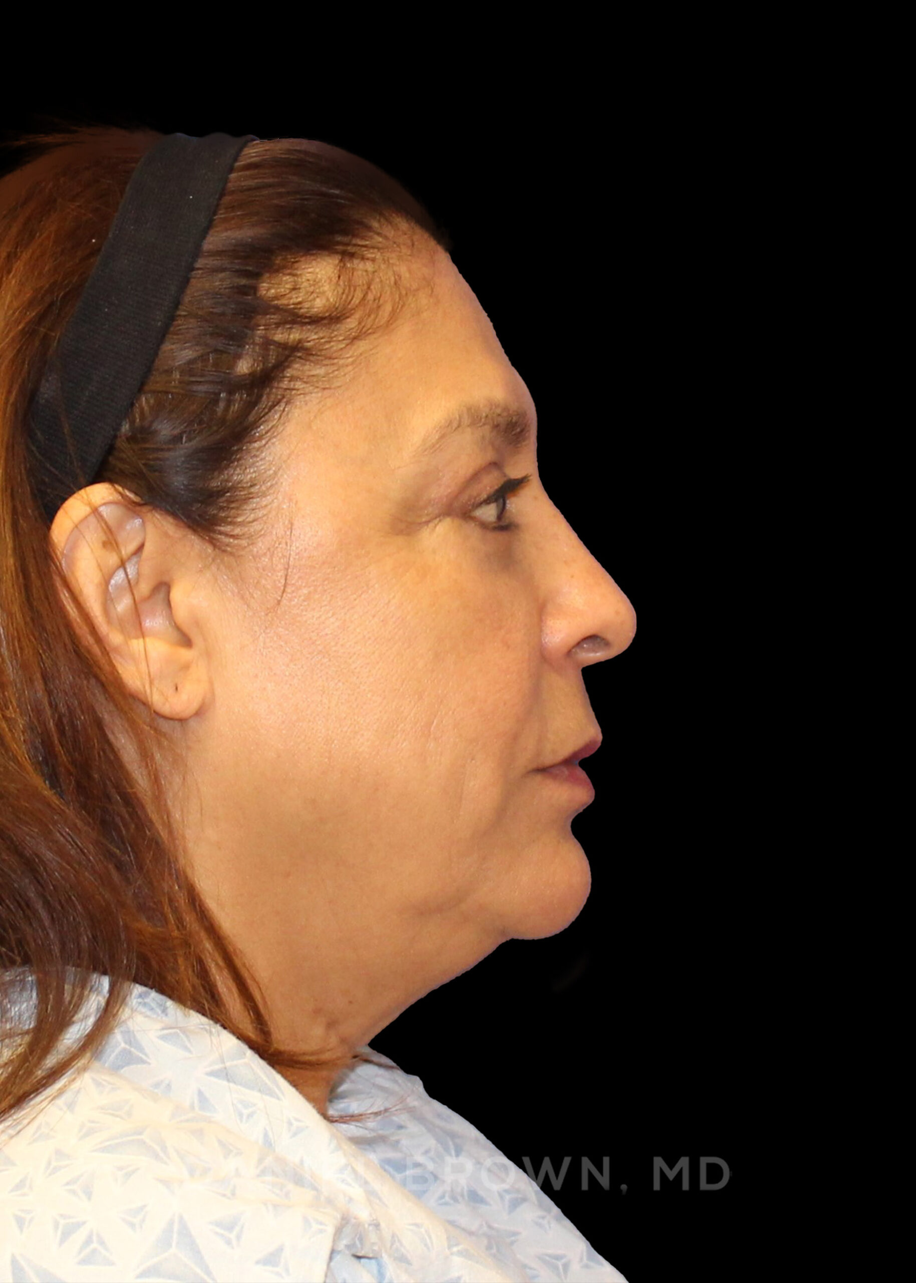Blepharoplasty Patient Photo - Case 915 - after view-6