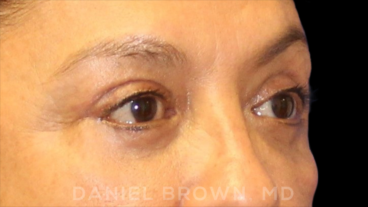 Blepharoplasty Patient Photo - Case 915 - after view