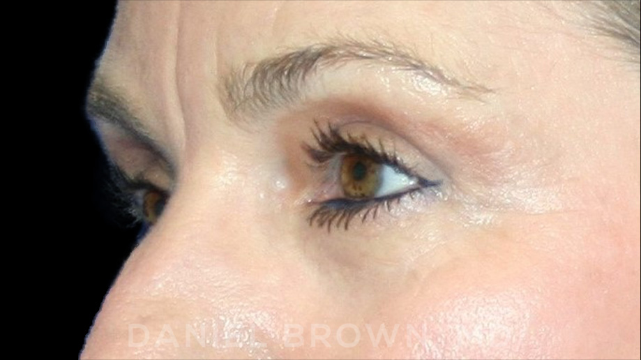 Blepharoplasty Patient Photo - Case 936 - after view-2
