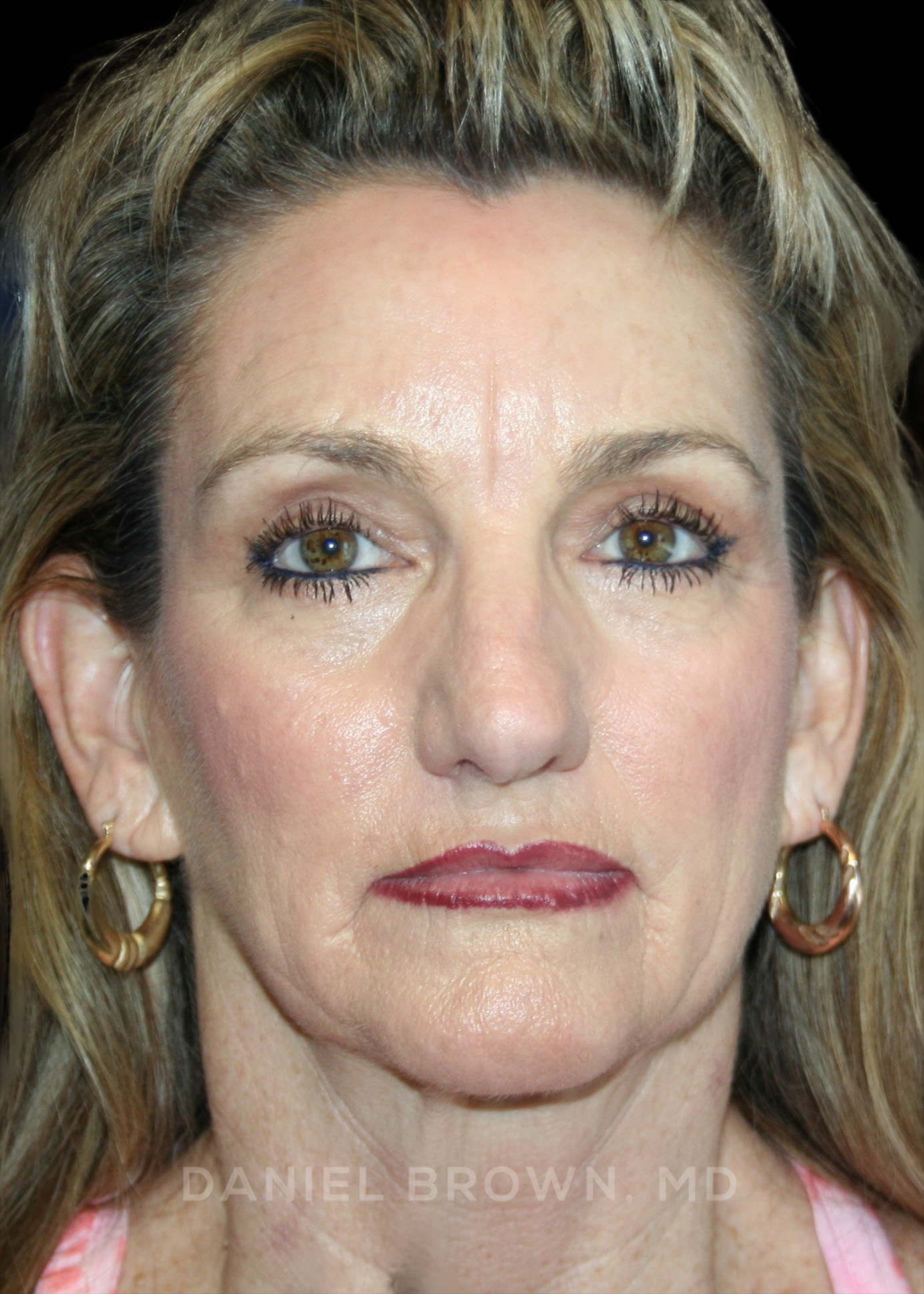 Blepharoplasty Patient Photo - Case 936 - after view-0