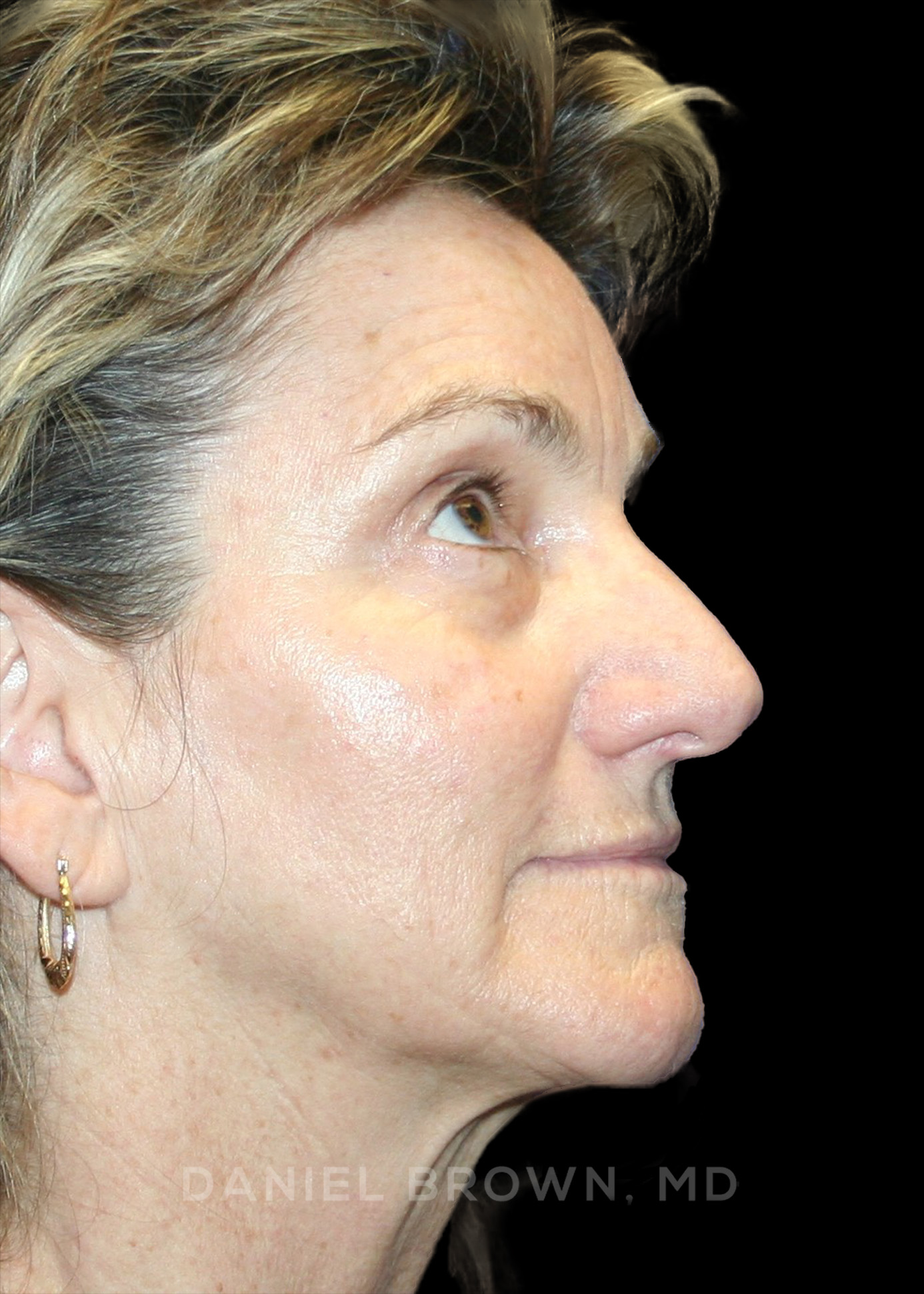 Blepharoplasty Patient Photo - Case 936 - before view-