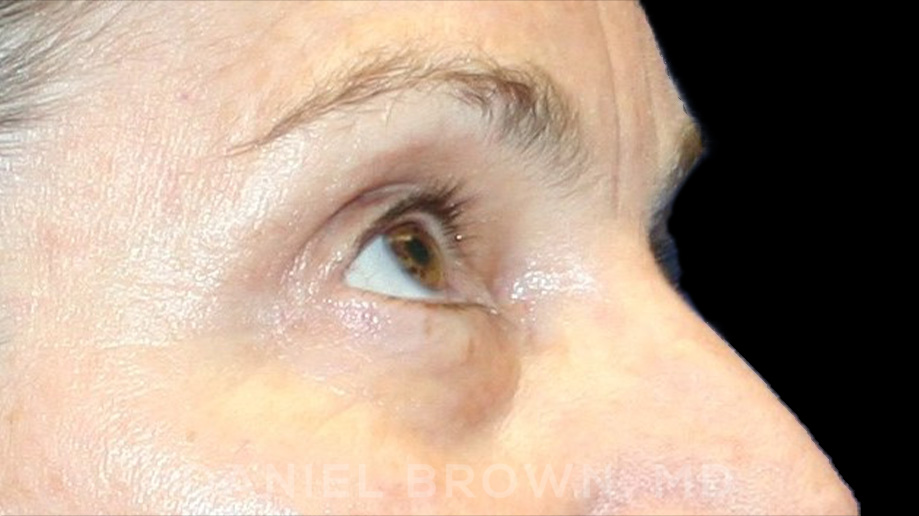 Blepharoplasty Patient Photo - Case 936 - before view-