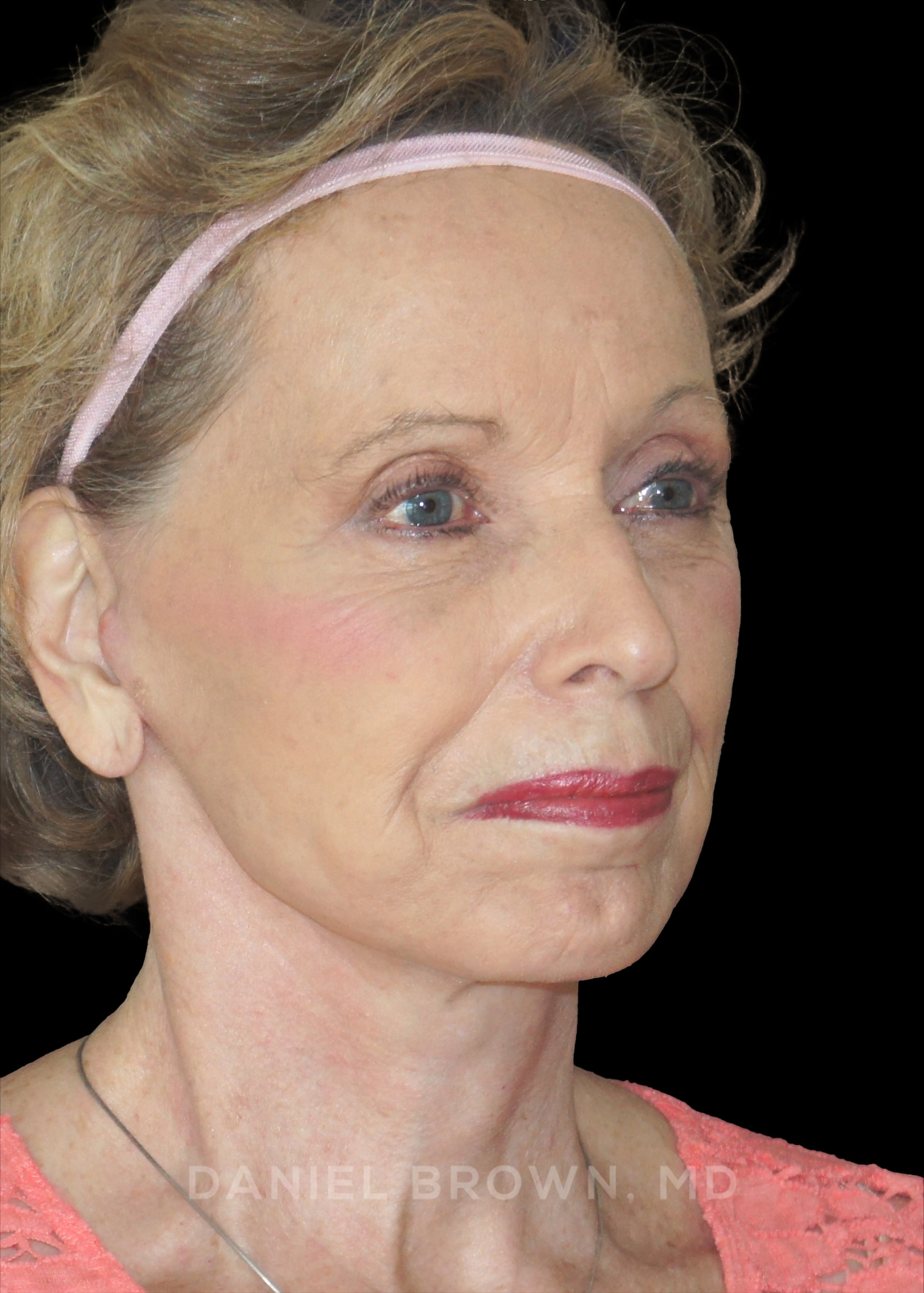 Blepharoplasty Patient Photo - Case 957 - after view-8