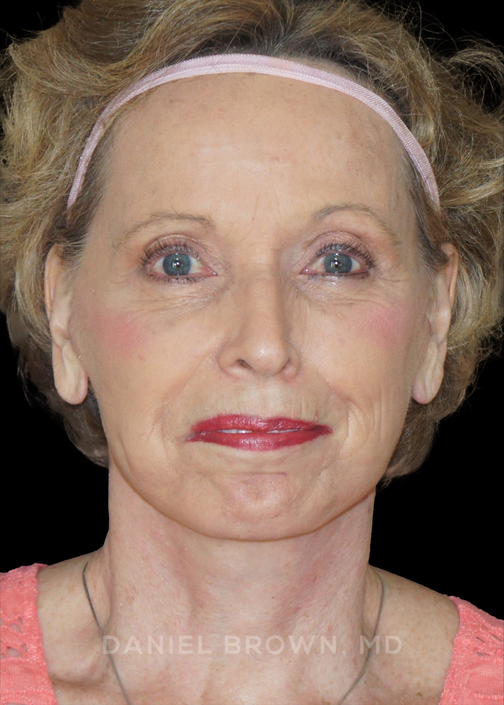 Blepharoplasty Patient Photo - Case 957 - after view-0