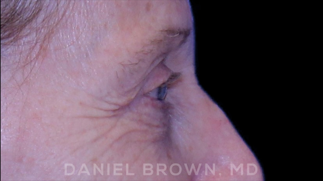 Blepharoplasty Patient Photo - Case 957 - before view-7