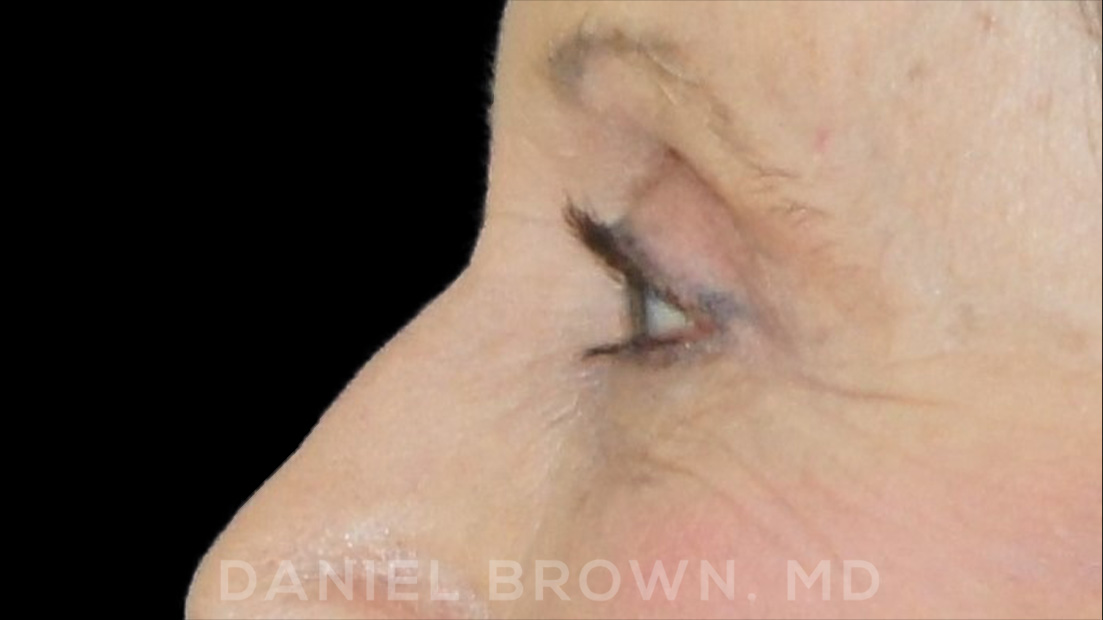 Blepharoplasty Patient Photo - Case 957 - after view-5
