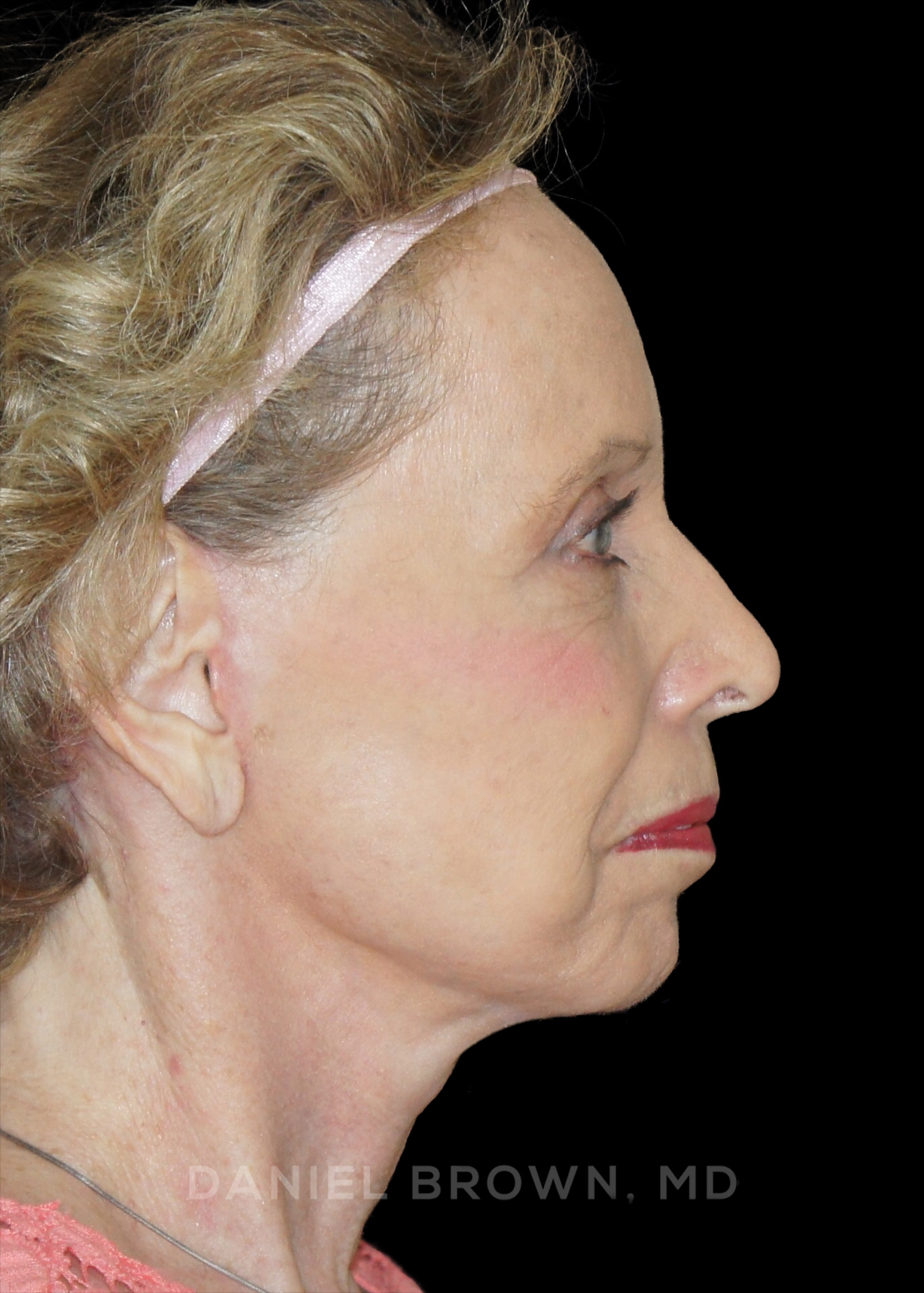 Blepharoplasty Patient Photo - Case 957 - after view-6