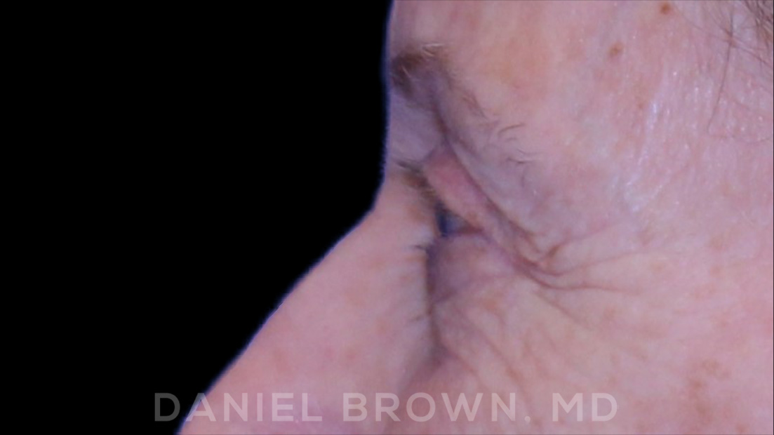 Blepharoplasty Patient Photo - Case 957 - before view-5
