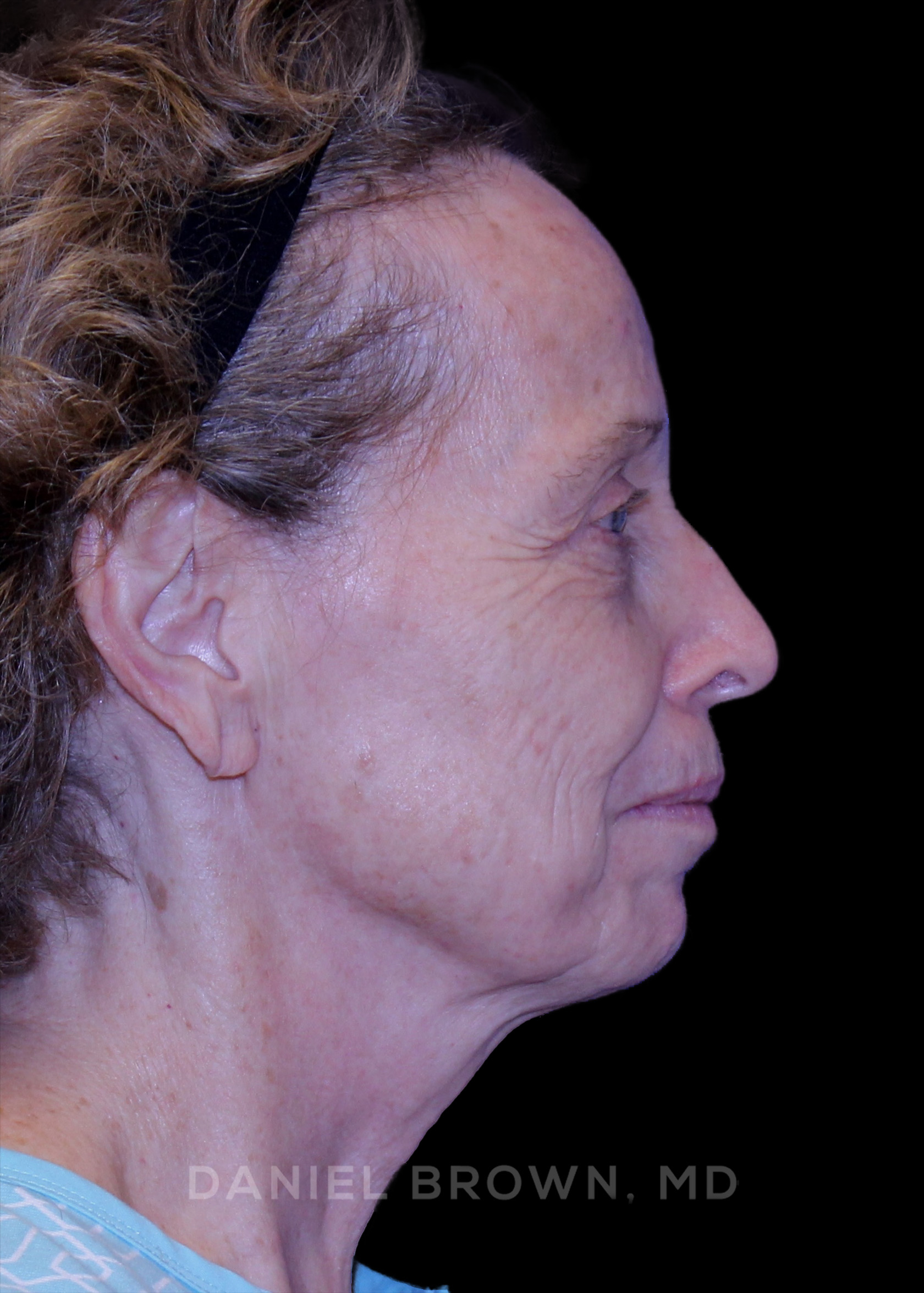 Blepharoplasty Patient Photo - Case 957 - before view-6