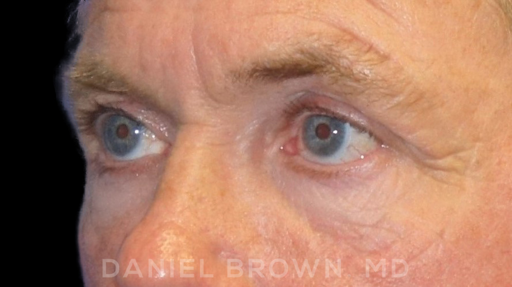 Blepharoplasty Patient Photo - Case 978 - before view-2
