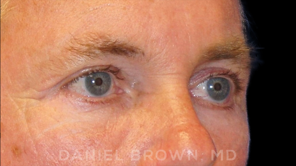 Blepharoplasty Patient Photo - Case 978 - after view