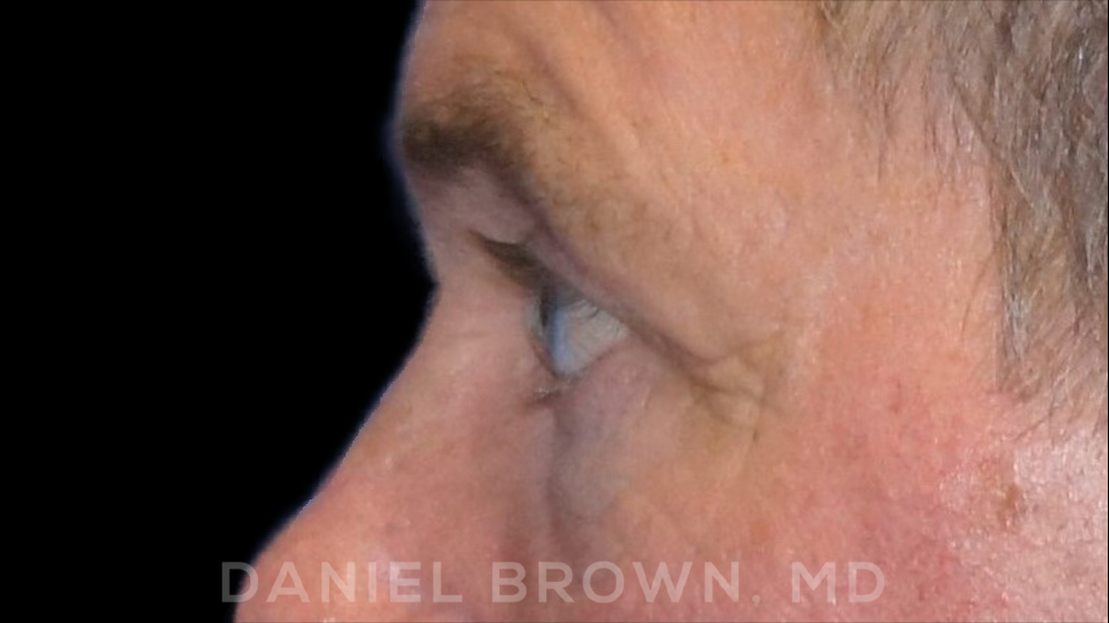 Blepharoplasty Patient Photo - Case 978 - before view-5