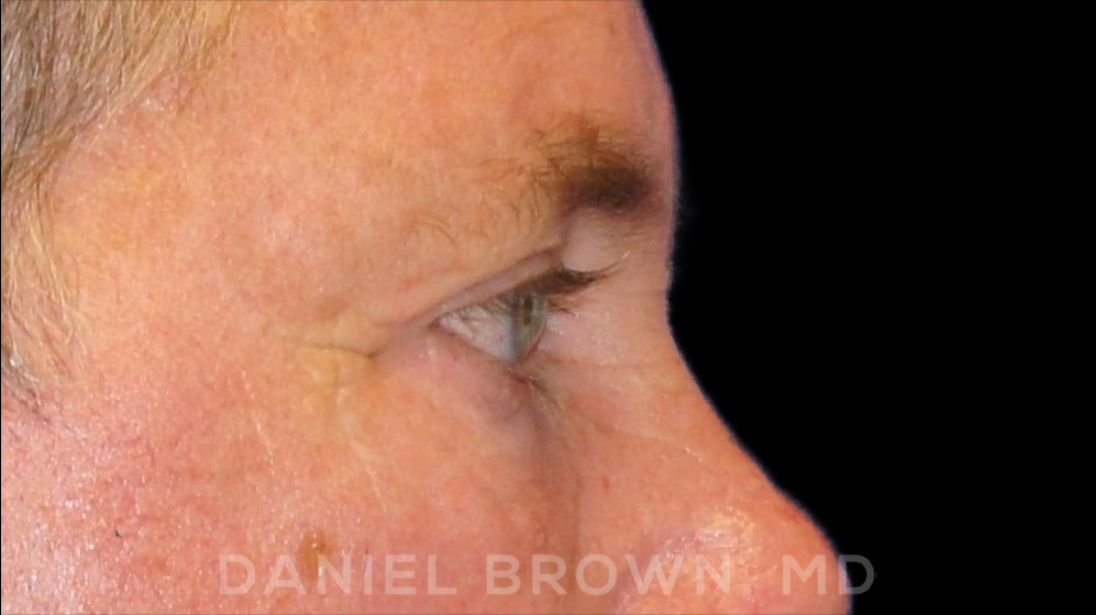 Blepharoplasty Patient Photo - Case 978 - after view