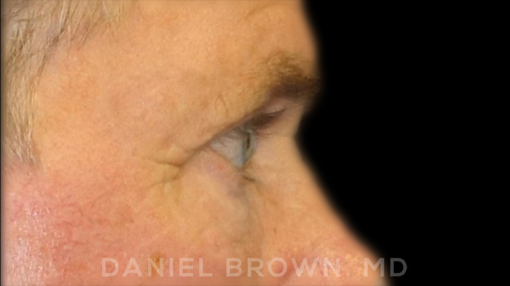 Blepharoplasty Patient Photo - Case 978 - before view-7