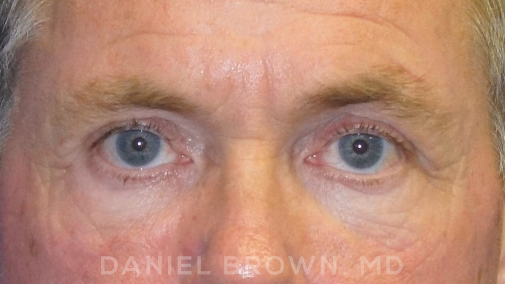Blepharoplasty Patient Photo - Case 978 - before view-1
