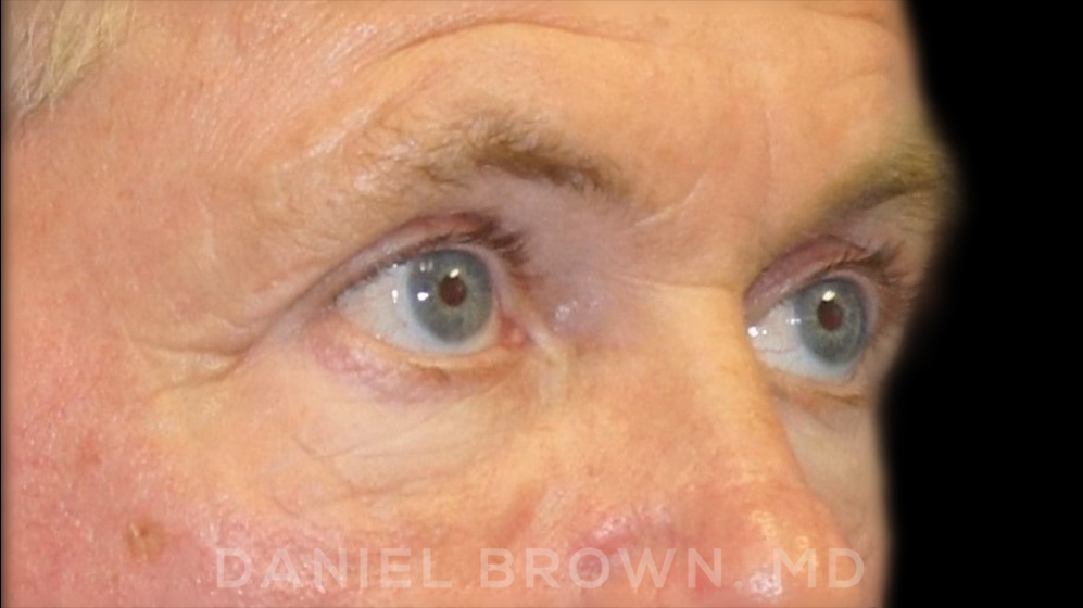Blepharoplasty Patient Photo - Case 978 - before view-9