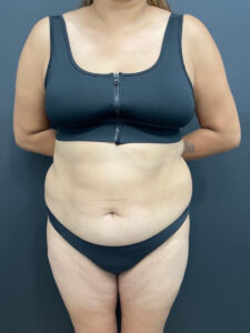 Liposuction - Case 4674 - Before