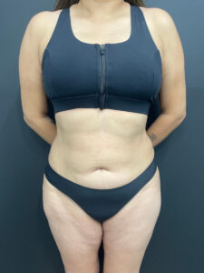 Liposuction - Case 4674 - After